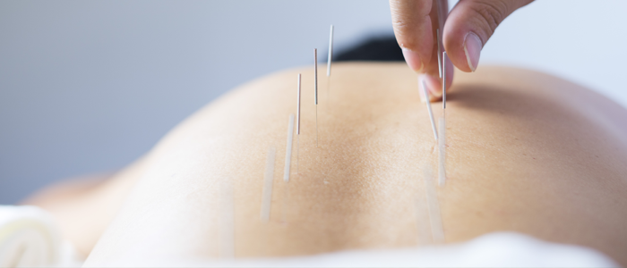 back pain and acupuncture